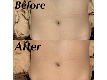 ビューティーデザインアウル(BEAUTY DESIGN OWL)/お腹脱毛Before→after