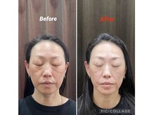 鍼灸チャンドラ(鍼灸Chandra)/女優鍼