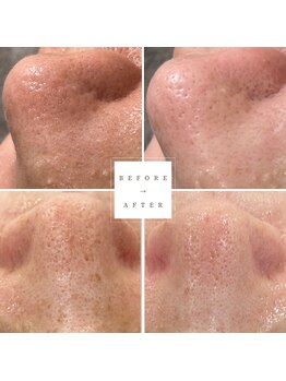 煌(kirameki)/感動毛穴洗浄Before→after