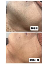 アカラ 読谷店(AKALA)/ヒゲ脱毛1ヶ月経過