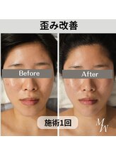 ミピマム/歪み改善+肌質改善