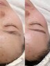 ★2ヶ月以内ご来店★ 美肌全顔フェイスWAX+鎮静パック
