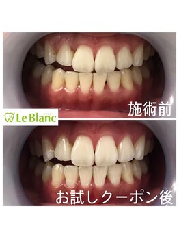 ルブラン 奈良店(Le Blanc)/当店のホワイトニングは