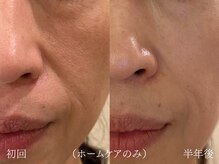 ウォーム(warm)/【肌質改善専門店warm】毛穴