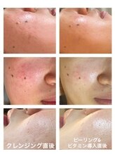 ルシュカ(Rasca)/ピーリング効果　1　1回の施術