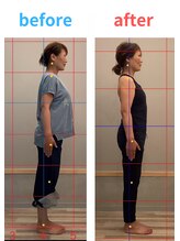 ハル鍼灸整骨院 池田院(HALU鍼灸整骨院)/ピラティス整体ビフォーアフター