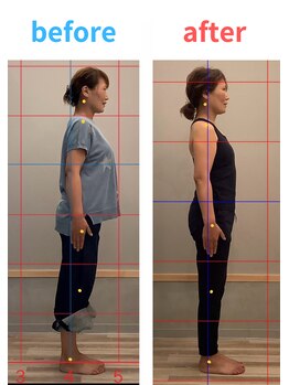 ハル鍼灸整骨院 池田院(HALU鍼灸整骨院)/ピラティス整体ビフォーアフター