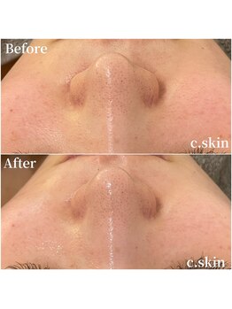 シースキン 盛岡駅前店(c.skin)/お客様ビフォーアフター♪