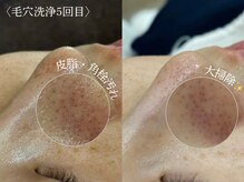 スー 千種 今池(Suu.)/韓国式毛穴洗浄"アクアピール"