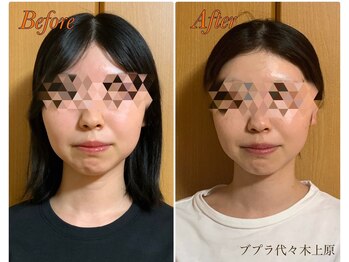 ブプラ 代々木上原店(BUPURA)/小顔×肌質改善