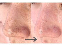 モネ(monet)/韓国式3D毛穴洗浄