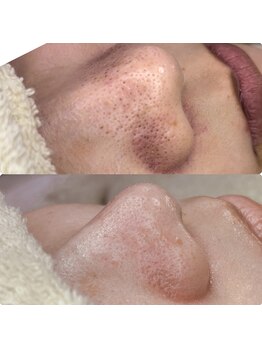 プアラ(puala)/ビフォーアフター