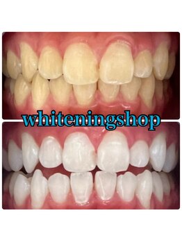 ホワイトニングショップ 高知店/ホワイトニング比較写真♪