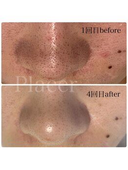 プラセル(Placer)/続けることで確実に/札幌/北区