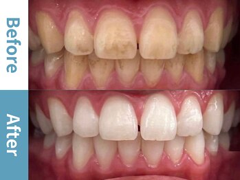 アース 岡崎店(EARTH)/【ビフォーアフター】美白