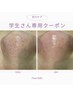 再来【学割Ｕ24】毛穴洗浄＆角栓吸引+鎮静パック ¥8,800→4,400 施術時間40分
