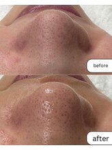 マーレ(MARE)/1回の施術でお肌の触り心地も◎