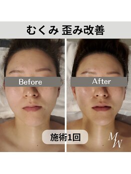 ミピマム/小顔コルギ