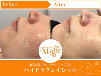 まいれ鍼灸院整骨院 整体院 草津院/ハイドラ／20代女性／施術4回