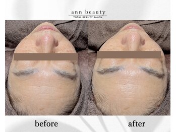 アン ビューティー(ann beauty)/施術1回【症例写真】