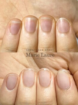 マリーロール 梅田店(Marie Laure)/自爪育成/深爪矯正/ネイルケア