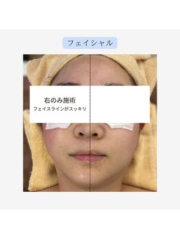 ジール(GIILL)/フェイシャルビフォーアフター