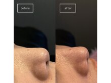 サンク(cinq)/頑固な毛穴にアプローチ☆彡