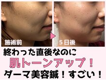 みき接骨院/姫路初ダーマ美容鍼＋ヒト幹細胞