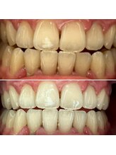 エピシアドットエヌ(epicia.N)/1日で驚く白さ