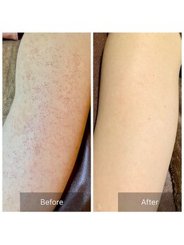 エミルカ 岡山店(EMILUCA)/二の腕の施術事例