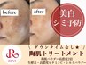【美白・シミ予防】ハーブピーリング＋贅沢オプション2種¥ 17500