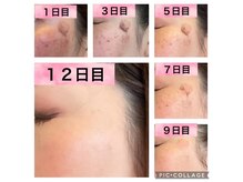 光フォトでシミケア◎最安値のこの価格！