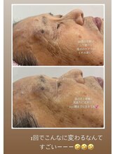 エスプラス エヌプラス(S+/N+)/フェイシャルエステ　ビフォアフ