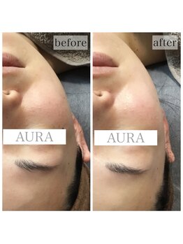 アウラ(AURA)/ダクトピール before/after