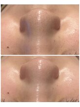 ホワイトアクア 浜松店(WHITE AQUA)/ハイドラワン/毛穴洗浄