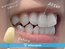 ホワイトニングカフェ赤羽店/ホワイトニングビフォーアフター
