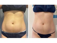 エイシスグロウ(asis glow.)/効果写真