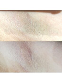 RiとBiのたまご/（脱毛）ワキ　７月～10月