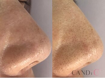 キャンディ 大阪梅田店(CANDi)/ハイドラピーリング/黒ずみ毛穴