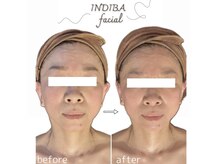 インディバ ベース(INDIBA BASE)の雰囲気（高周波が加齢の原因にアプローチ！ハリ艶UPでマイナス5歳肌へ）