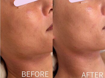 ケアズ(CARES)/ハーブピーリング