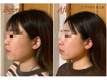 ブプラ 代々木上原店(BUPURA)/小顔×透明感UP