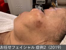 オアシスラグーン(OASIS LAGOON)/お任せフェイシャル（症例2）