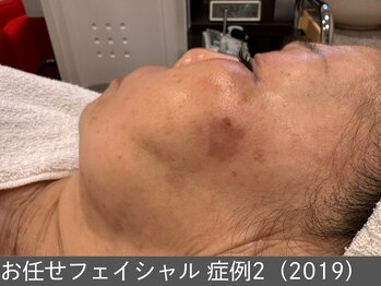 オアシスラグーン(OASIS LAGOON)/お任せフェイシャル(症例2)