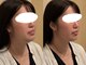 ルミエール 田原町 蔵前(Lumiere)の写真/エアーインジェクターで頬のたるみや二重顎、フェイスラインを引き締め！むくみをケアしてすっきり小顔へ♪