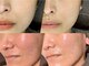 スリースリー 恵比寿(THREE THREE)の写真/【老け顔、卒業】痛みなく"ほうれい線・たるみ改善"。まずは肌のハリ不足解消から◎肌をキュッと引き締め！