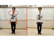 仙台療術センター/姿勢改善による体の変化（正面）