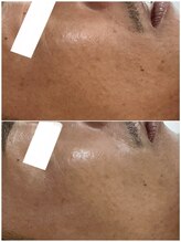 フェリノ(FERINO)/夏の日焼けダメージは即ケアを！