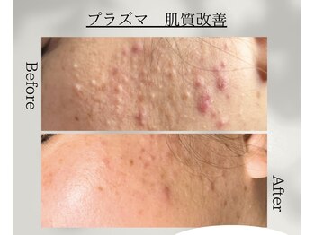 アノネ(Anone.)/プラズマ抗菌ニキビケア