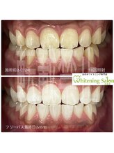 ホワイトニングサロン 広島店/【ホワイトニング18回照射】